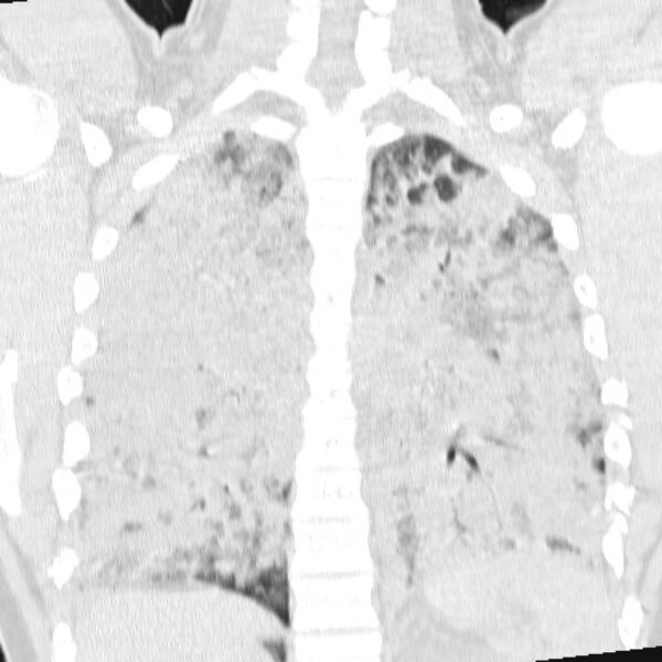File:Acute aspiration pneumonitis (Radiopaedia 33605-34703 Coronal lung window 56).jpg