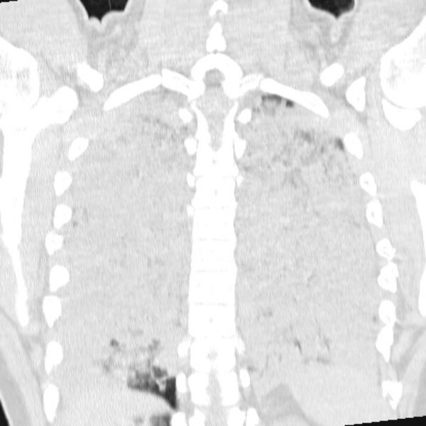 File:Acute aspiration pneumonitis (Radiopaedia 33605-34703 Coronal lung window 61).jpg