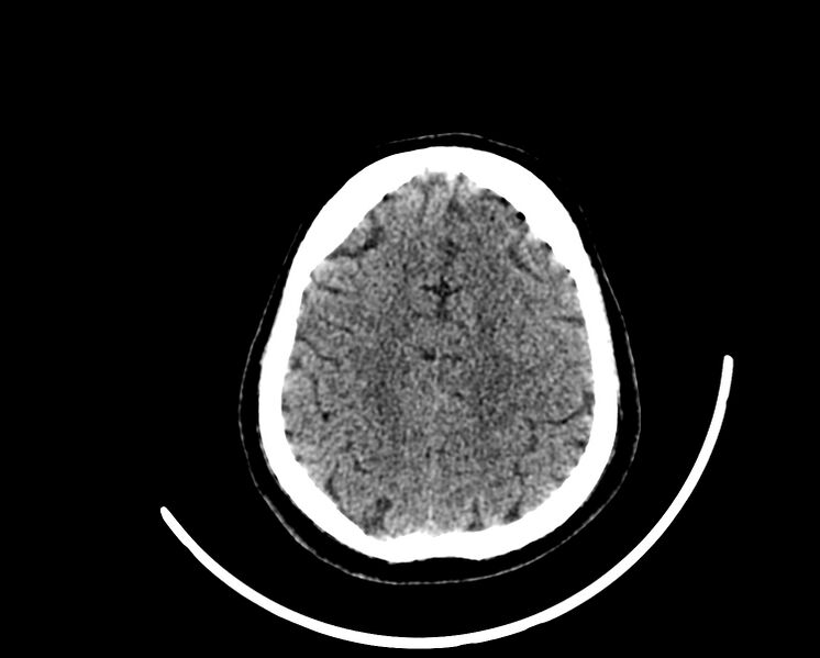 File:Acute cerebral infarct (Radiopaedia 35604-37123 Axial non-contrast 80).jpg