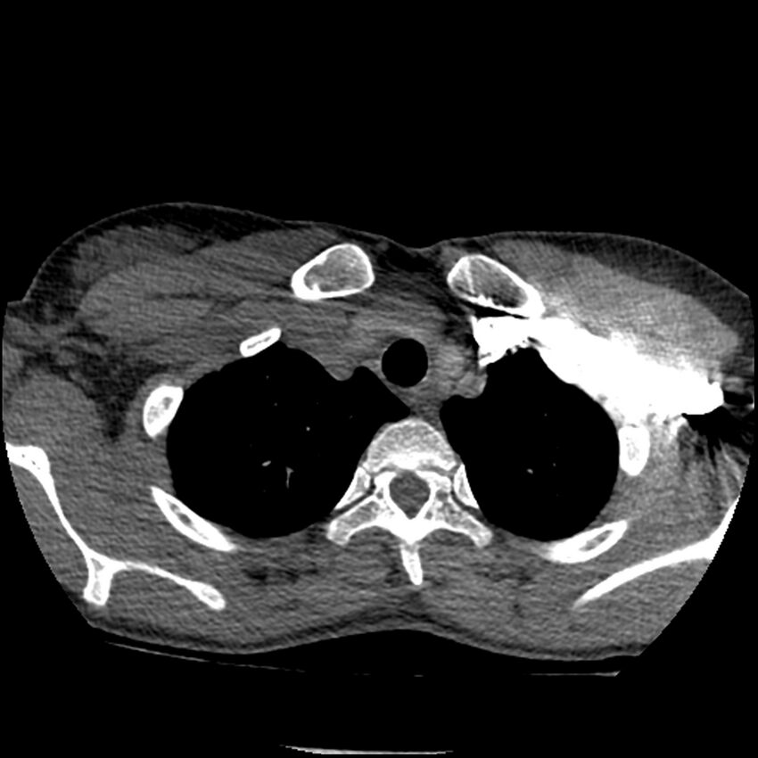 Acute chest syndrome - sickle cell disease (Radiopaedia 42375-45499 Axial C+ CTPA 31).jpg