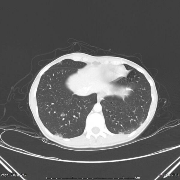 File:Acute eosinophilic pneumonia (Radiopaedia 48211-53073 Axial lung window 75).jpg