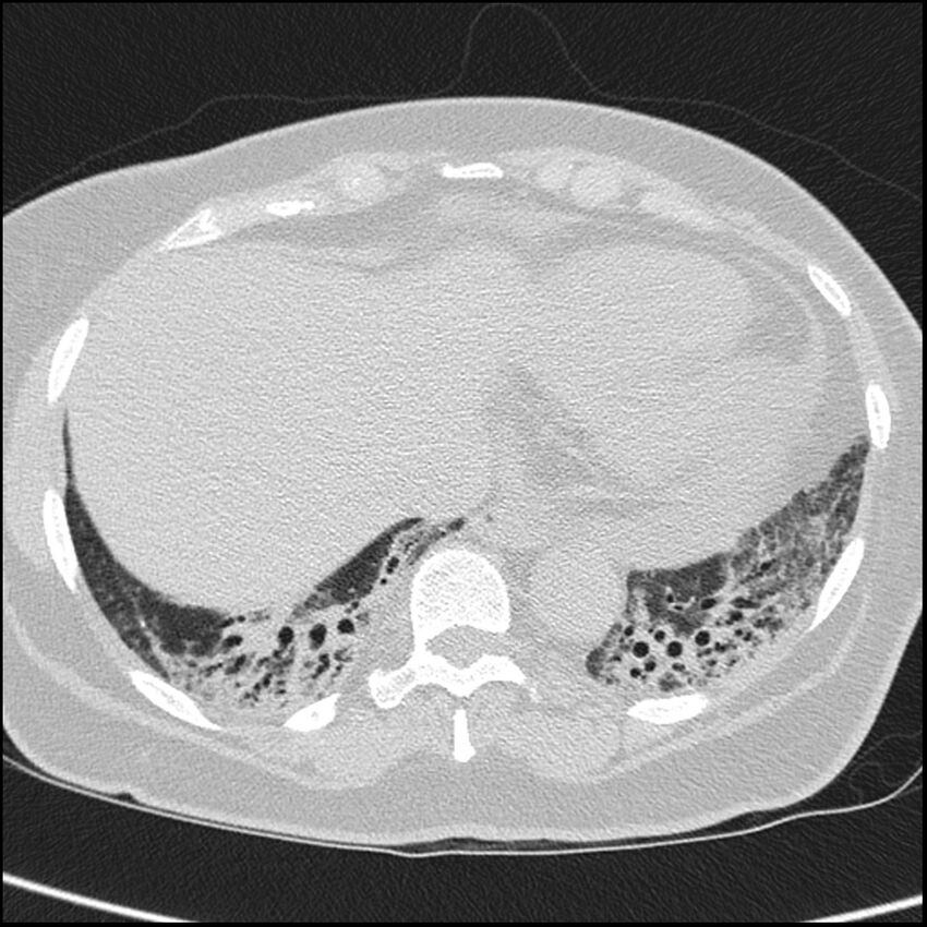 Acute interstitial pneumonitis (Radiopaedia 45404-49453 Axial lung window 63).jpg
