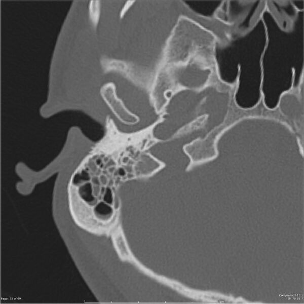 File:Acute otomastoiditis (Radiopaedia 28276-28512 Axial PTB bone window reformat 55).jpg