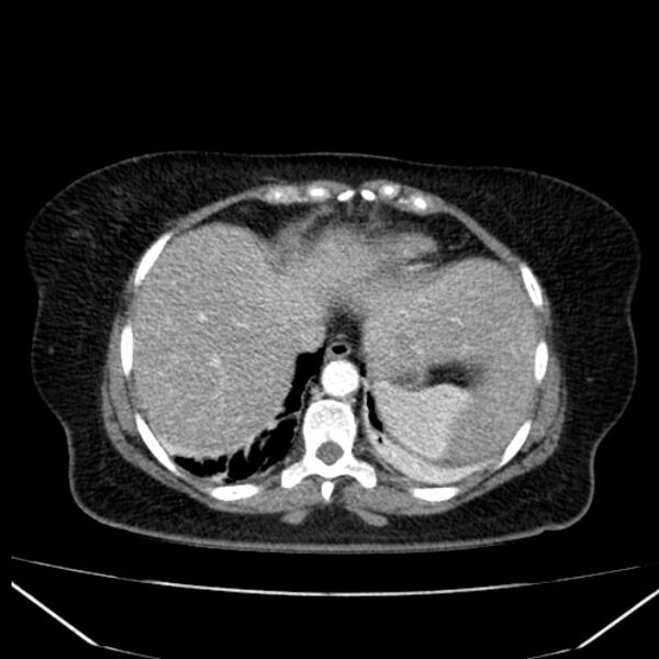 File:Acute pancreatitis - Balthazar C (Radiopaedia 26569-26714 Axial C+ arterial phase 11).jpg