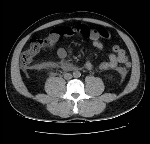 File:Acute pancreatitis - Balthazar E (Radiopaedia 23080-23110 Axial non-contrast 41).jpg