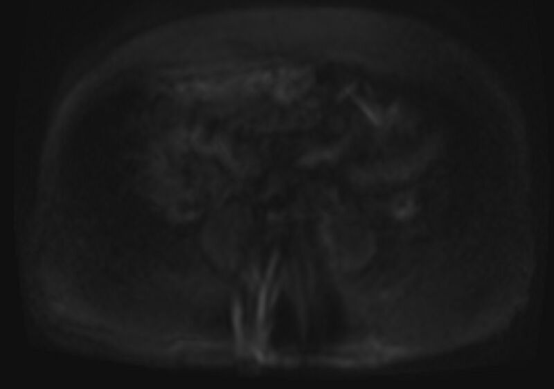 File:Acute portal vein thrombosis (Radiopaedia 73198-83925 Axial DWI 60).jpg