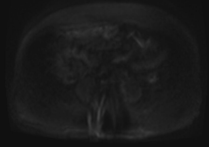 Acute portal vein thrombosis (Radiopaedia 73198-83925 Axial DWI 60).jpg