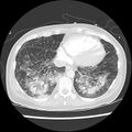 Acute pulmonary edema on CT (Radiopaedia 33582-34672 Axial lung window 41).jpg