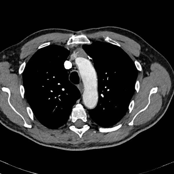File:Acute pulmonary embolism (Radiopaedia 81677-95570 Axial C+ CTPA 8).jpg