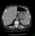 Acute renal failure post IV contrast injection- CT findings (Radiopaedia 47815-52559 Axial C+ portal venous phase 17).jpg