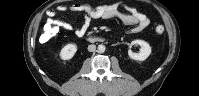 Acute sigmoid colon diverticulitis (Radiopaedia 55507-61976 Axial C+ portal venous phase 6).jpg