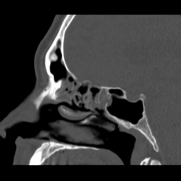 File:Acute sinusitis (Radiopaedia 23161-23215 Sagittal bone window 35).jpg