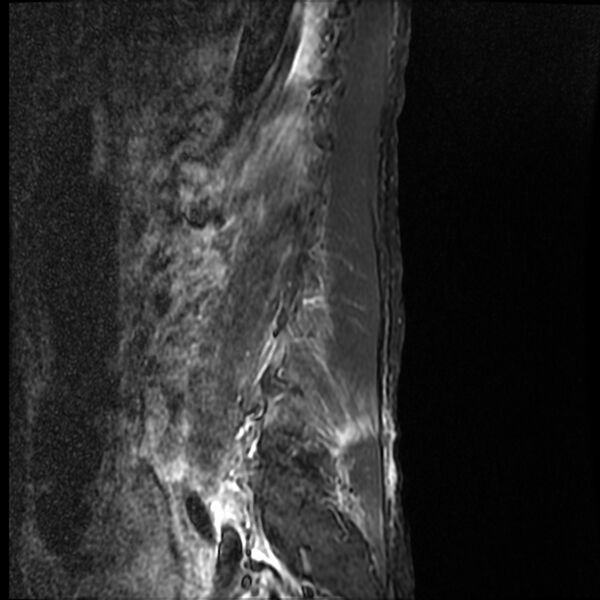 File:Acute vertebral body compression fractures (Radiopaedia 31757-32694 Sagittal STIR 1).jpg