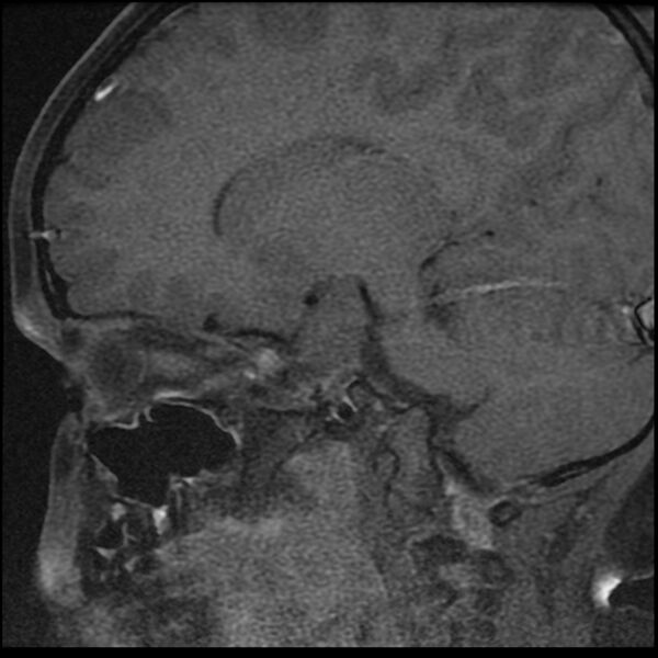 File:Adamantinomatous craniopharyngioma (Radiopaedia 77407-89529 Sagittal T1 C+ fat sat 3).jpg