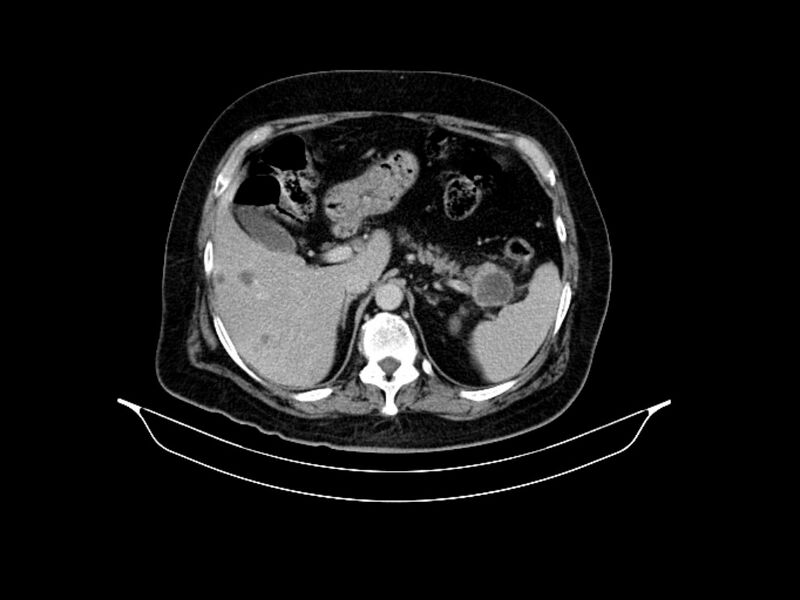 File:Adenocarcinoma of pancreas with hepatic metastasis (Radiopaedia 64332-73122 Axial C+ delayed 29).jpg