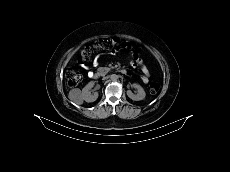 File:Adenocarcinoma of pancreas with hepatic metastasis (Radiopaedia 64332-73122 Axial non-contrast 44).jpg