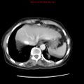 Adenocarcinoma of the colon (Radiopaedia 8191-9039 Axial liver window 12).jpg