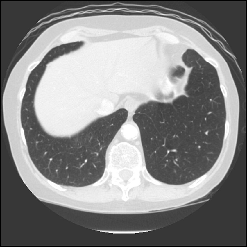 Adenocarcinoma of the lung (Radiopaedia 41015-43755 Axial lung window 103).jpg