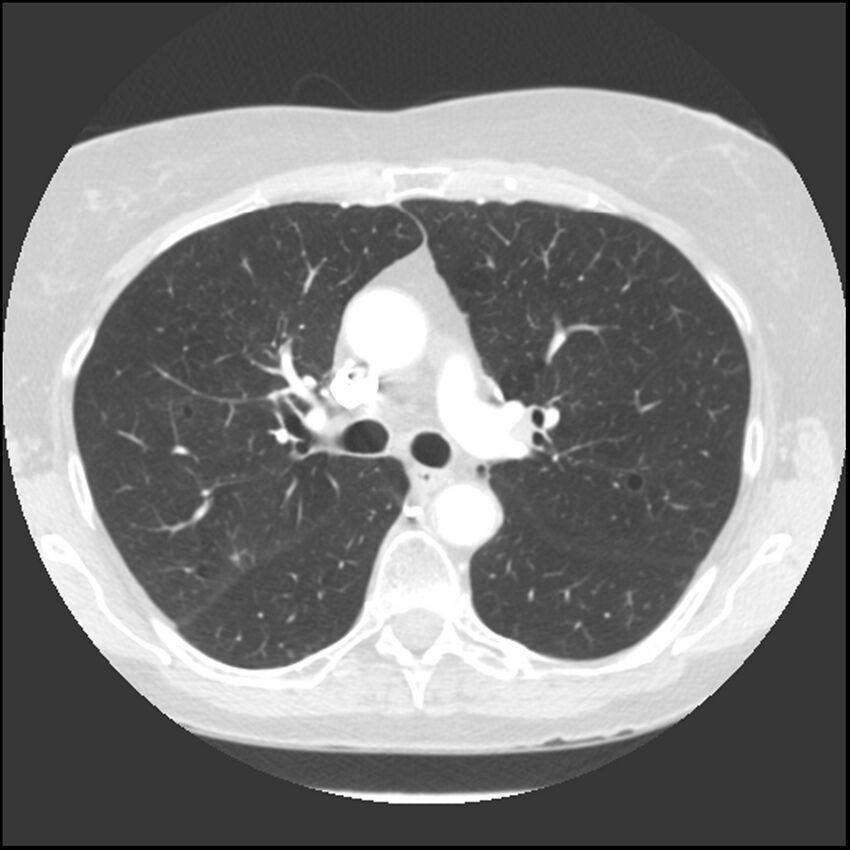 Adenocarcinoma of the lung (Radiopaedia 41015-43755 Axial lung window 47).jpg
