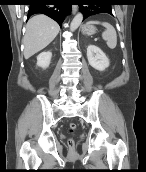 File:Adenocarcioma of rectum- T1 lesion (Radiopaedia 36921-38547 Coronal C+ portal venous phase 43).png