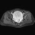 Adenomyoma of the uterus (huge) (Radiopaedia 9870-10438 Axial T1 C+ fat sat 14).jpg