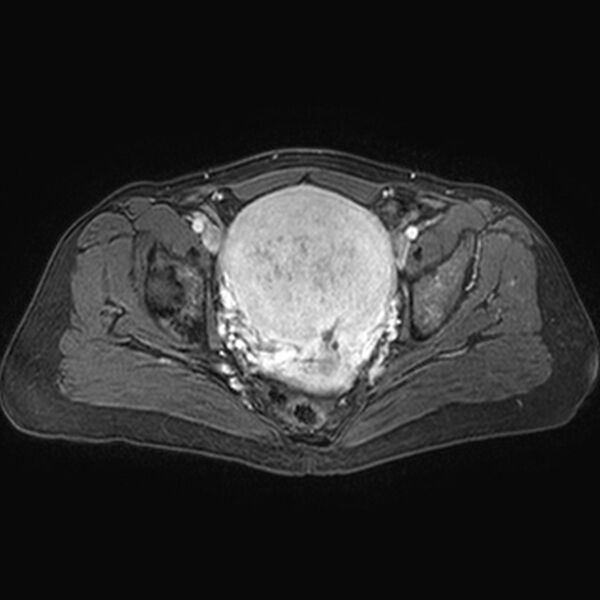 File:Adenomyoma of the uterus (huge) (Radiopaedia 9870-10438 Axial T1 C+ fat sat 14).jpg