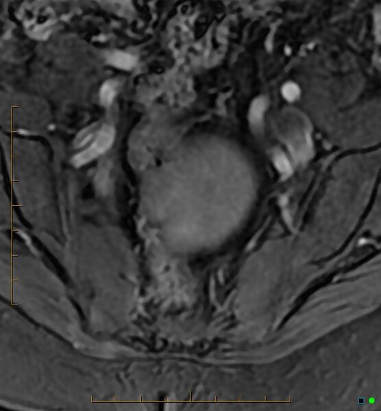 File:Adenomyosis uterus with hematometra (Radiopaedia 45779-50011 Axial T1 C+ fat sat 2).jpg