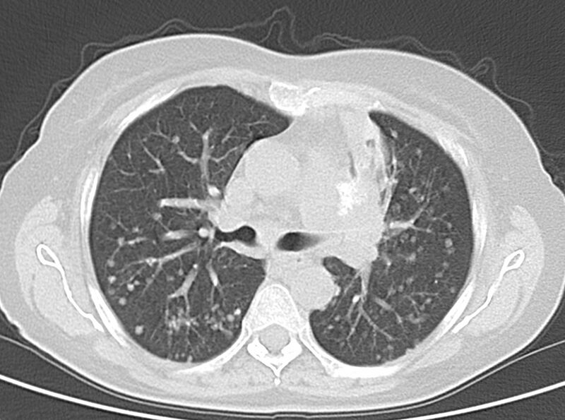 File:Adenosquamous lung carcinoma (Radiopaedia 22035-22030 lung window 28).jpg