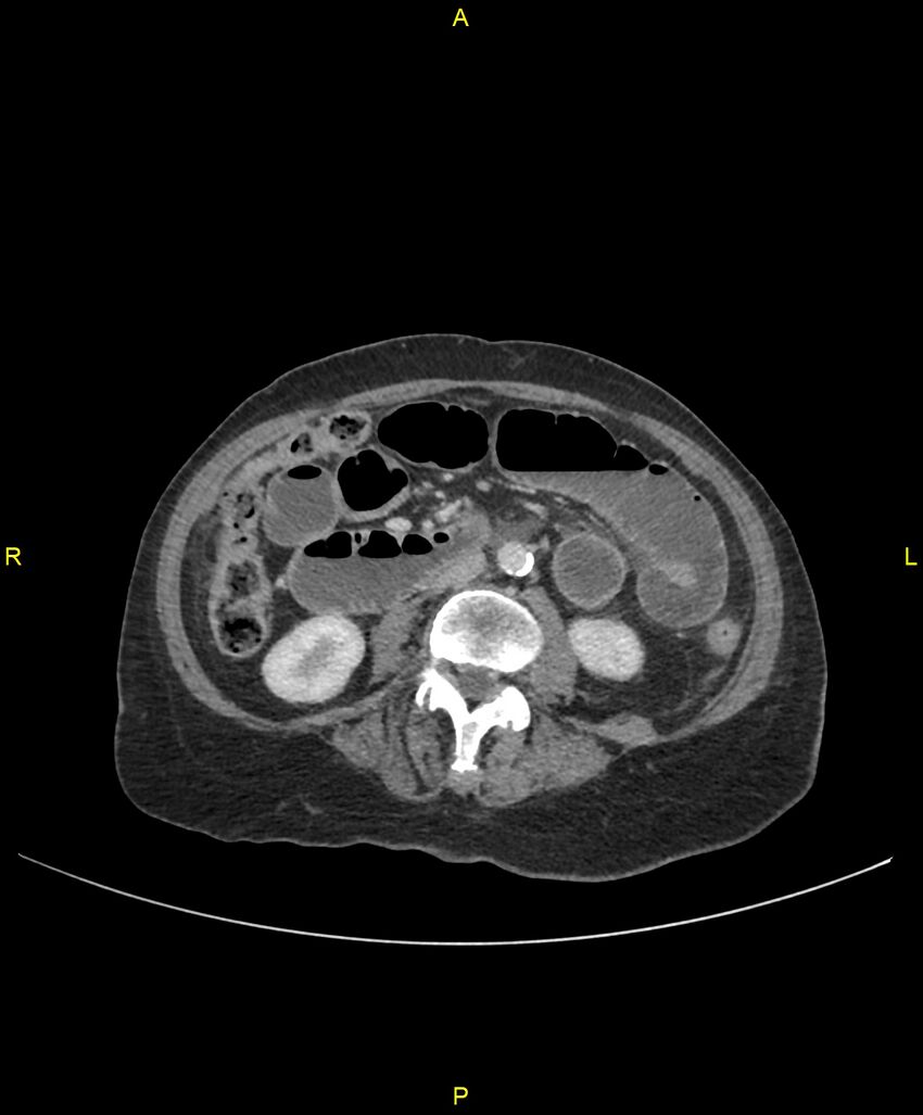 Adhesional small bowel obstruction (Radiopaedia 85402-101024 Axial C+ portal venous phase 144).jpg