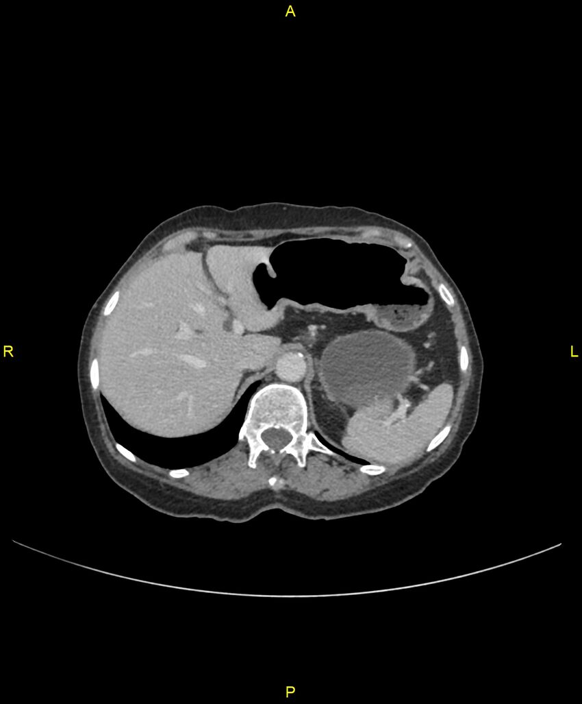 Adhesional small bowel obstruction (Radiopaedia 85402-101024 Axial C+ portal venous phase 64).jpg