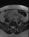 Adnexal multilocular cyst (O-RADS US 3- O-RADS MRI 3) (Radiopaedia 87426-103754 Axial T2 2).jpg