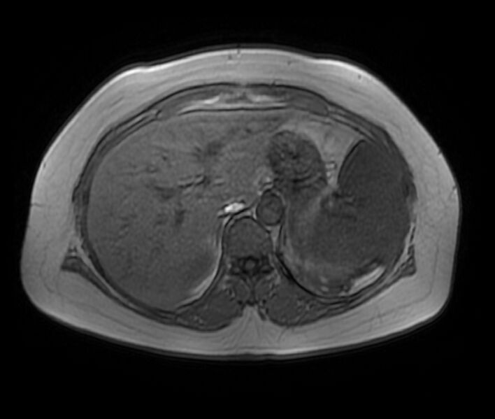 File:Adrenal cortical carcinoma (Radiopaedia 70906-81116 Axial T1 in-phase-out-of-phase 12).jpg