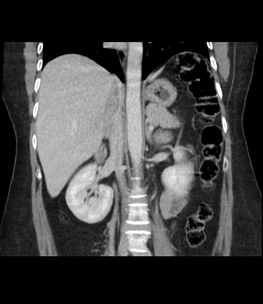 File:Adrenal cortical carcinoma with IVC invasion and thrombosis (Radiopaedia 34307-35597 Coronal C+ portal venous phase 29).jpg