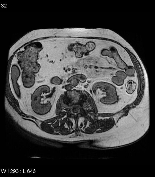 File:Adrenal myelolipoma (Radiopaedia 6765-7961 Axial T1 out-of-phase 32).jpg