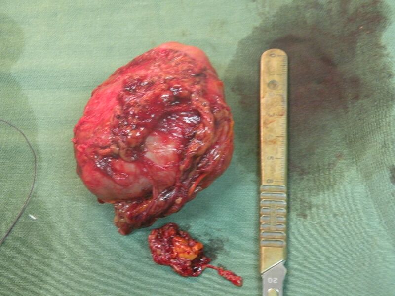 File:Adrenal pheochromocytoma (Radiopaedia 35133-38713 Immediately after resection 1).JPG