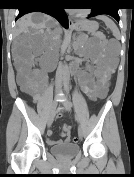 File:Adult polycystic kidney disease (Radiopaedia 47866-52626 Coronal non-contrast 26).png
