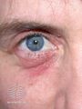 Airborne contact dermatitis eyelid (DermNet NZ contact-dermatitis-eyelid-airborne).jpg