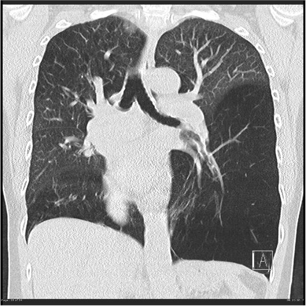 File:Alpha-1-antitrypsin deficiency (Radiopaedia 26537-26678 Coronal lung window 18).jpg