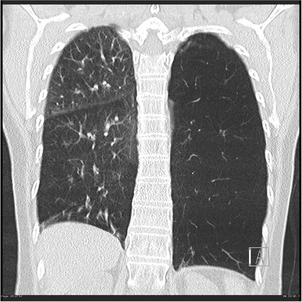 File:Alpha-1-antitrypsin deficiency (Radiopaedia 26537-26678 Coronal lung window 26).jpg