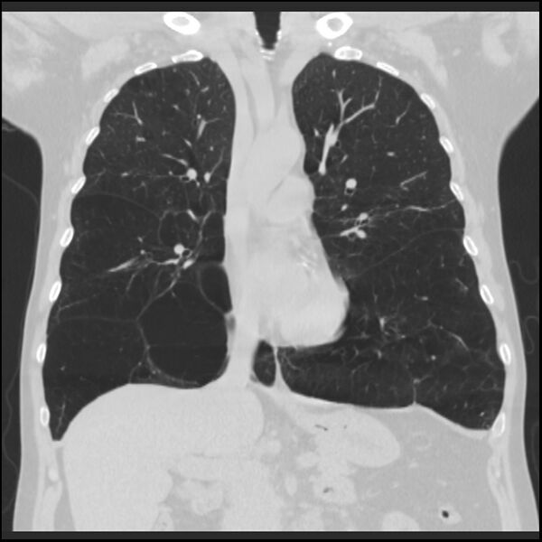 File:Alpha-1-antitrypsin deficiency (Radiopaedia 40993-43722 Coronal lung window 43).jpg