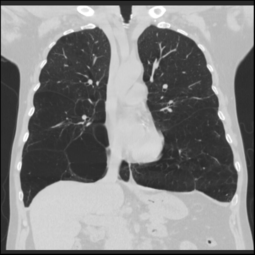 Alpha-1-antitrypsin deficiency (Radiopaedia 40993-43722 Coronal lung window 43).jpg