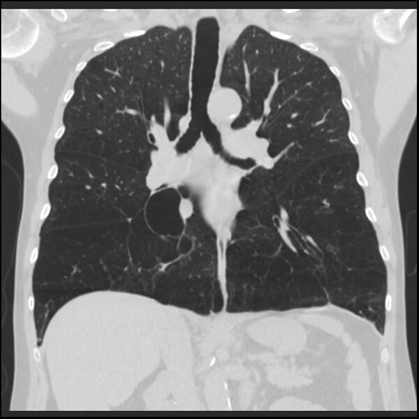 File:Alpha-1-antitrypsin deficiency (Radiopaedia 40993-43722 Coronal lung window 53).jpg