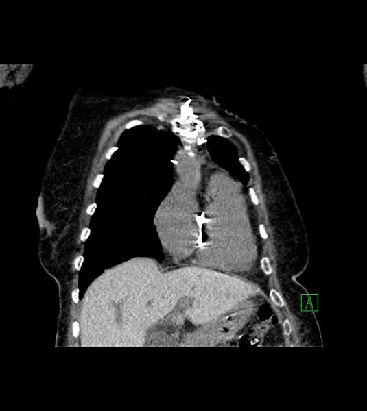File:Amiodarone deposition in the liver (Radiopaedia 77587-89780 Coronal non-contrast 23).jpg