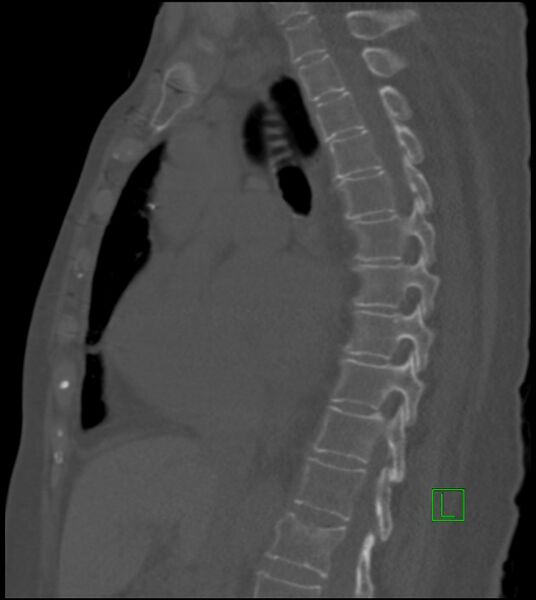 File:Amiodarone deposition in the liver (Radiopaedia 77587-89780 Sagittal bone window 52).jpg