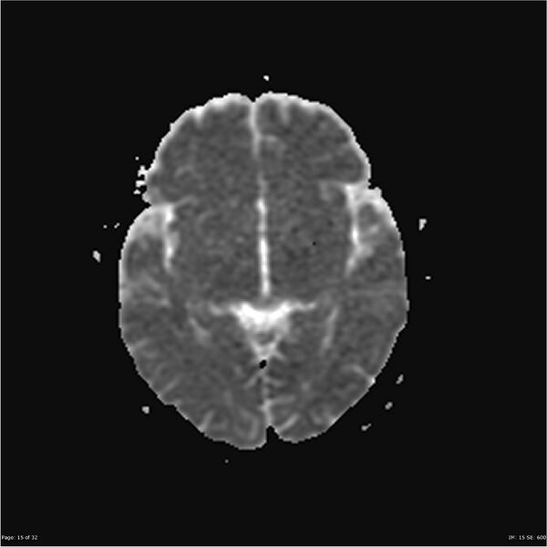 File:Amnestic syndrome secondary to hypoxic brain injury (Radiopaedia 24743-25004 ADC 15).jpg