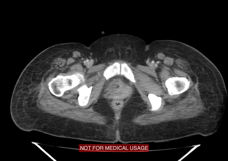 File:Amoebic enterocolitis with liver abscess (Radiopaedia 35100-36609 A 83).jpg