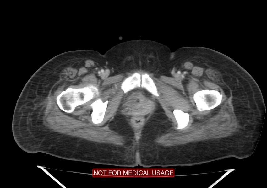 Amoebic enterocolitis with liver abscess (Radiopaedia 35100-36609 A 83).jpg