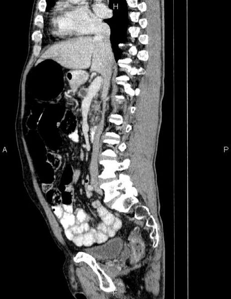 File:Ampullary adenocarcinoma (Radiopaedia 86093-102032 D 42).jpg