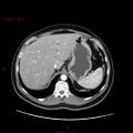 Ampullary carcinoma (Radiopaedia 56396-63056 B 18).jpg