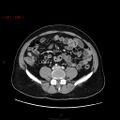 Ampullary carcinoma (Radiopaedia 56396-63056 C 64).jpg